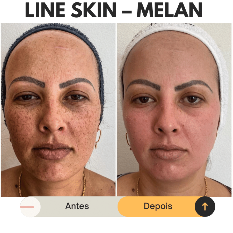 melan skin2